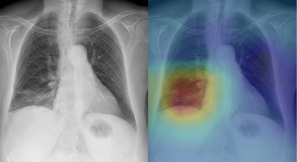 Two X-rays of the lungs, one in grayscale and one overlaid with rainbow colors centered on the left lung.