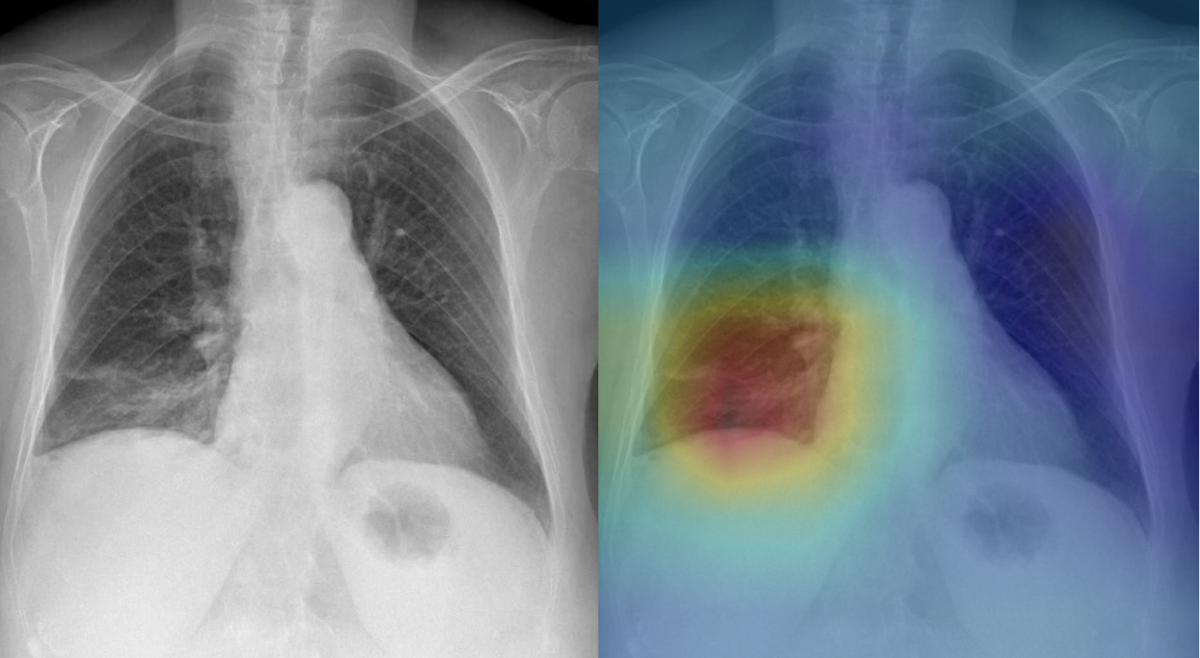 Deep Learning To Identify COVID-19 In Chest X-rays - Johns Hopkins ...