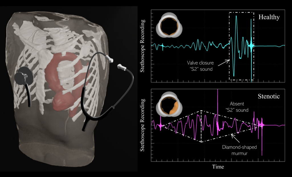 Virtual stethoscope recordings from biomechanics simulations (left) can be used to develop an algorithm which can accurately recognize acoustic features of heart sounds from healthy (right; top) and stenotic (right; bottom) aortic valves. This technology can alleviate the diagnostic subjectivity of manual auscultation and enable at-home, inexpensive self-monitoring.