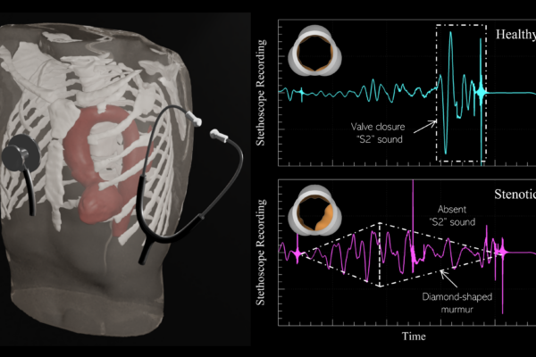 Virtual stethoscope recordings from biomechanics simulations (left) can be used to develop an algorithm which can accurately recognize acoustic features of heart sounds from healthy (right; top) and stenotic (right; bottom) aortic valves. This technology can alleviate the diagnostic subjectivity of manual auscultation and enable at-home, inexpensive self-monitoring.