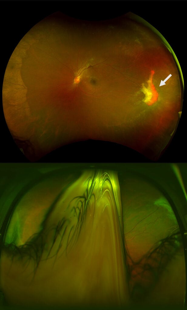Two ultra-widefield retina photographs in separate patients with sickle cell disease