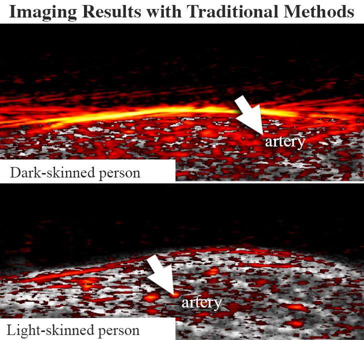 Comparison of two volunteers, where imaging through darker skin shows more signal clutter obscuring arteries than through light skin.