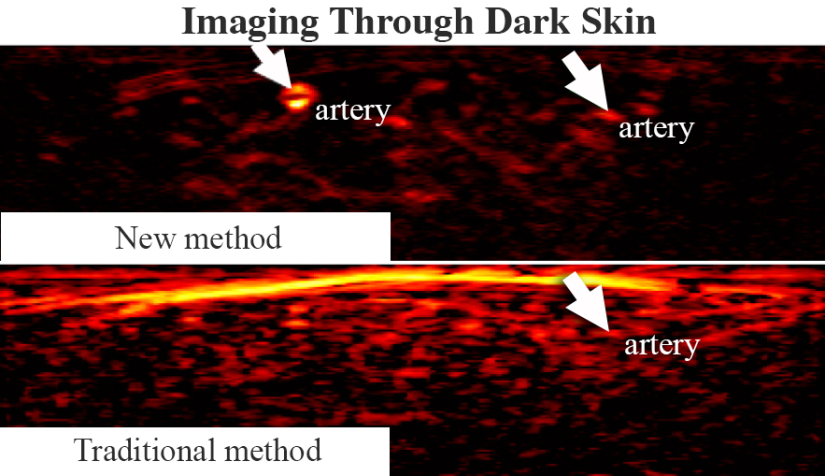 Comparison of the same dark-skinned participant show images made with conventional methods are cluttered, while the new imaging technique makes arteries easier to spot.