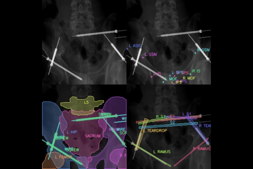 Four overlays of a simulated pelvic X-ray image. The top left has no overlay. The top right has anatomical landmarks labeled. The bottom left shows semantic segmentation annotations for the bones and orthopedic hardware. The bottom right are more specific segmentations for bony corridors that the procedure is targeting.