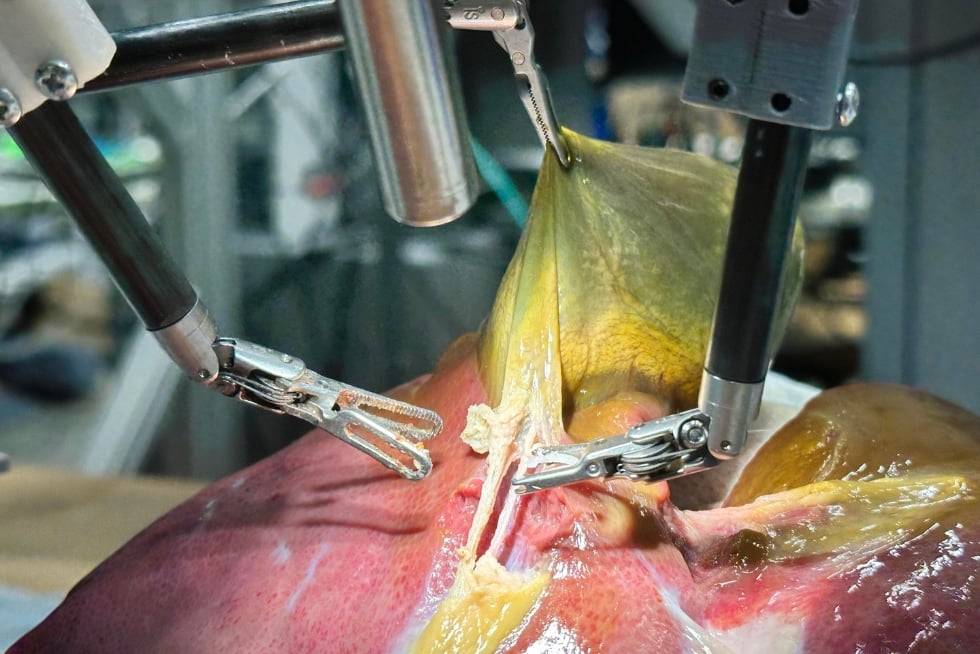 The Surgical Robot Transformer-Hierarchy performing a gallbladder surgery.