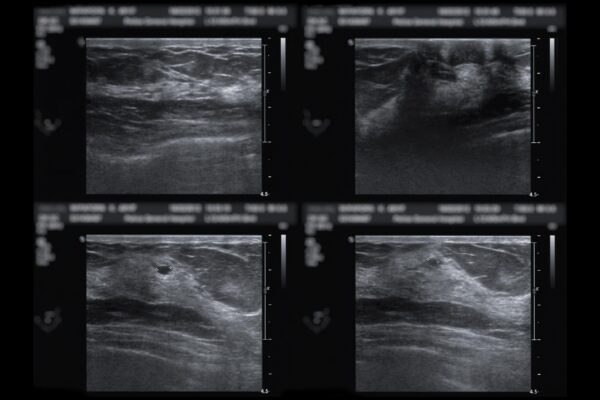 Four ultrasounds of breasts after mammographies for diagnosis, isolated on black background.